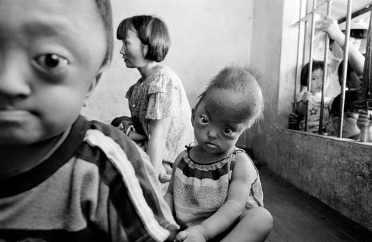 Missbildung von Kindern durch die Auswirkungen von Agent Orange - Agentorange-Vietnam
